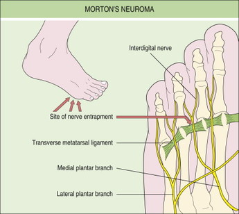 Morton's Neuroma - Foot Pain
